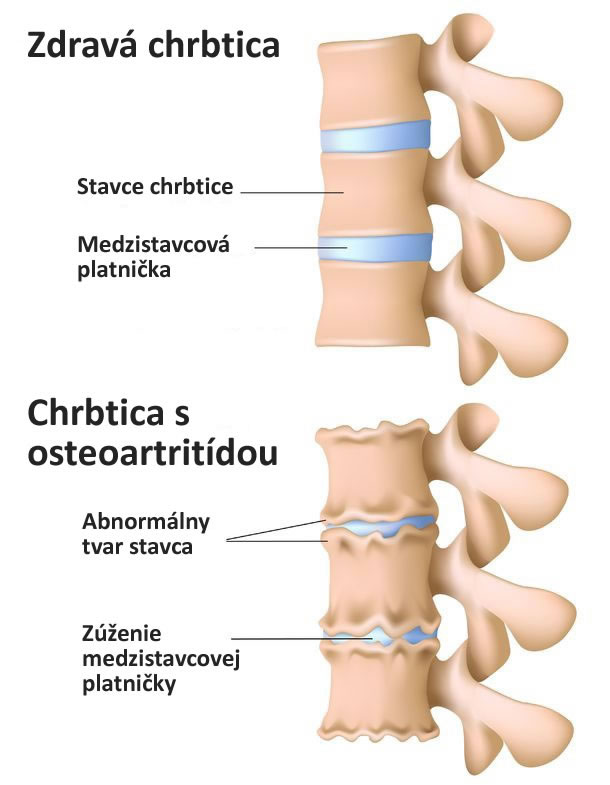 Osteoartritida, artritida chrbtice